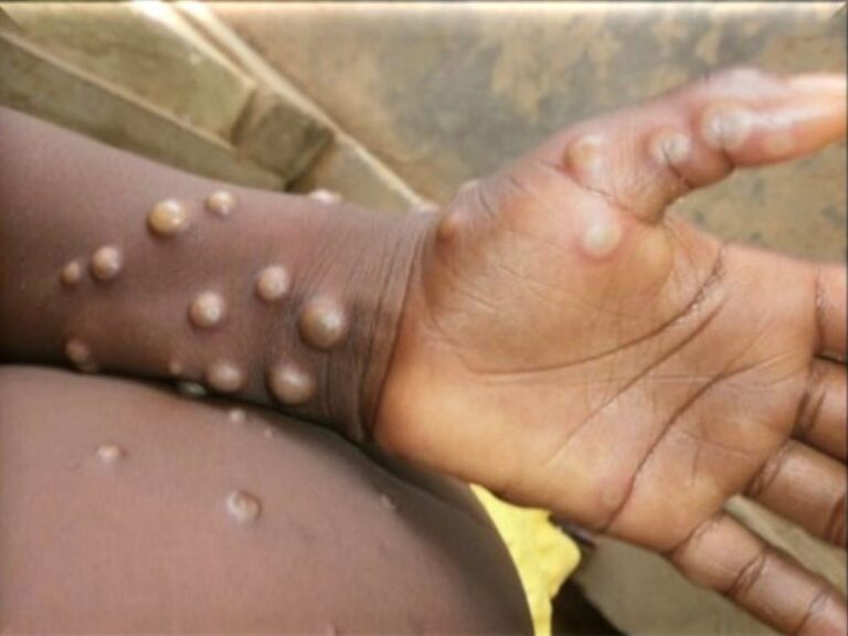Going Ape for Monkeypox!