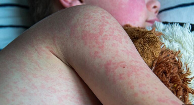 There is no such thing as Measles!